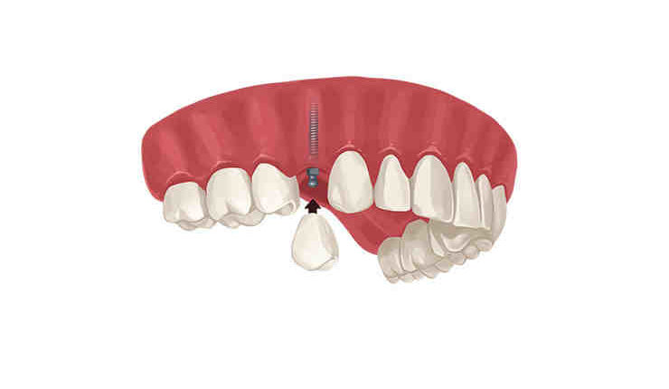 What if you can't afford dental implants