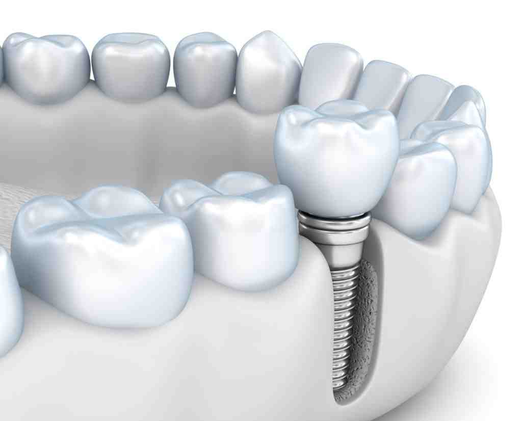 Does the va do dental implants Dental News Network