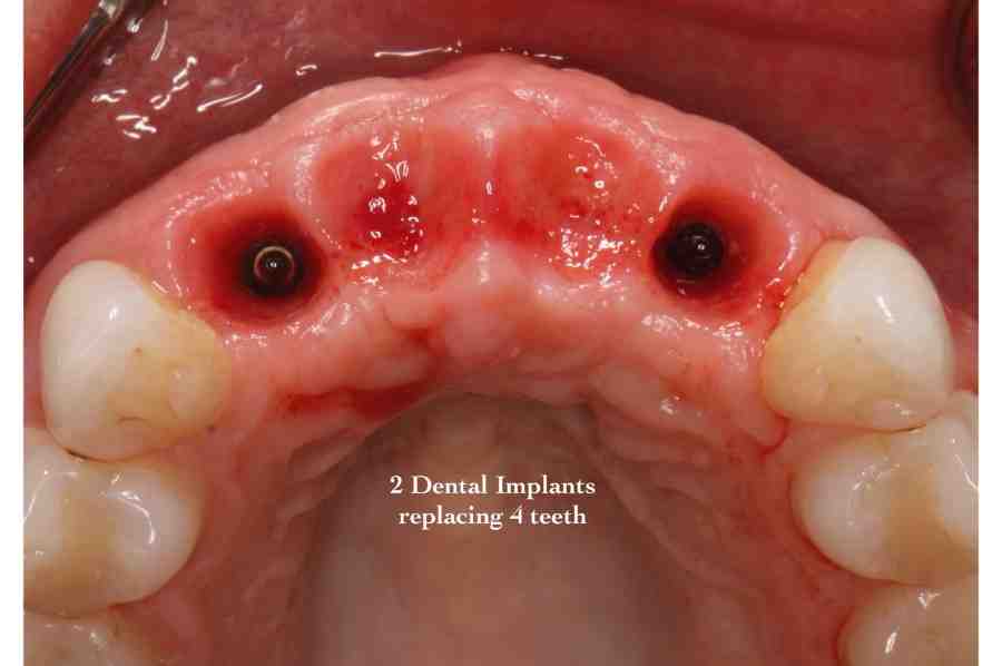 What is a contraindication for considering a patient for dental implants?