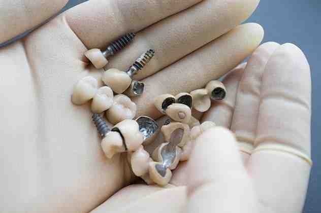 What is a reasonable price for dental implants?