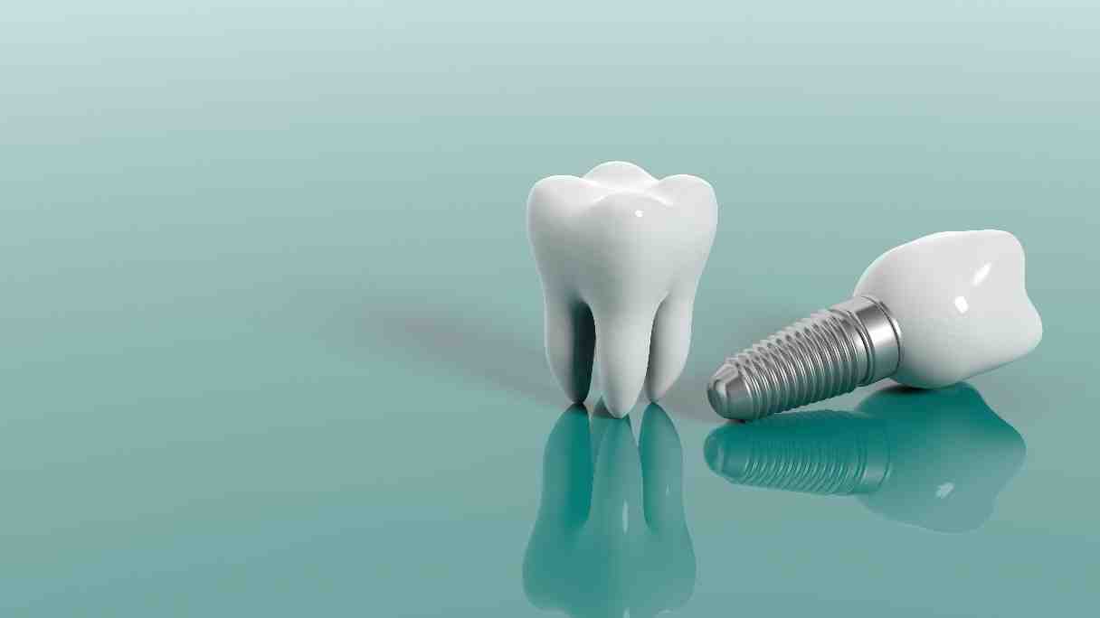 What is a reasonable price for dental implants?