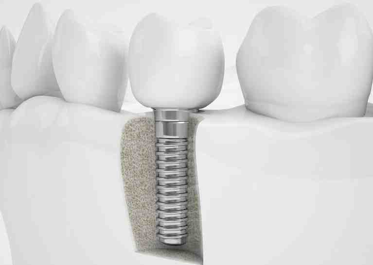 What is a dental implant made of Dental News Network
