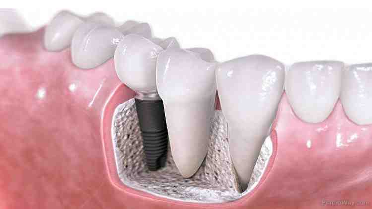What is the average price for full mouth dental implants?