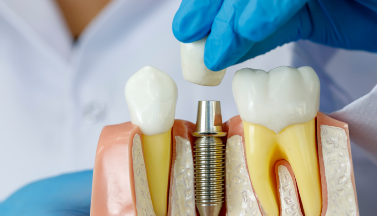 What is the average price of a dental implant