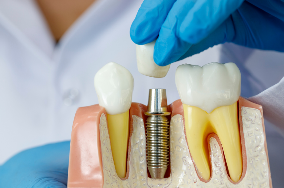 what-is-the-average-price-of-a-dental-implant-dental-news-network