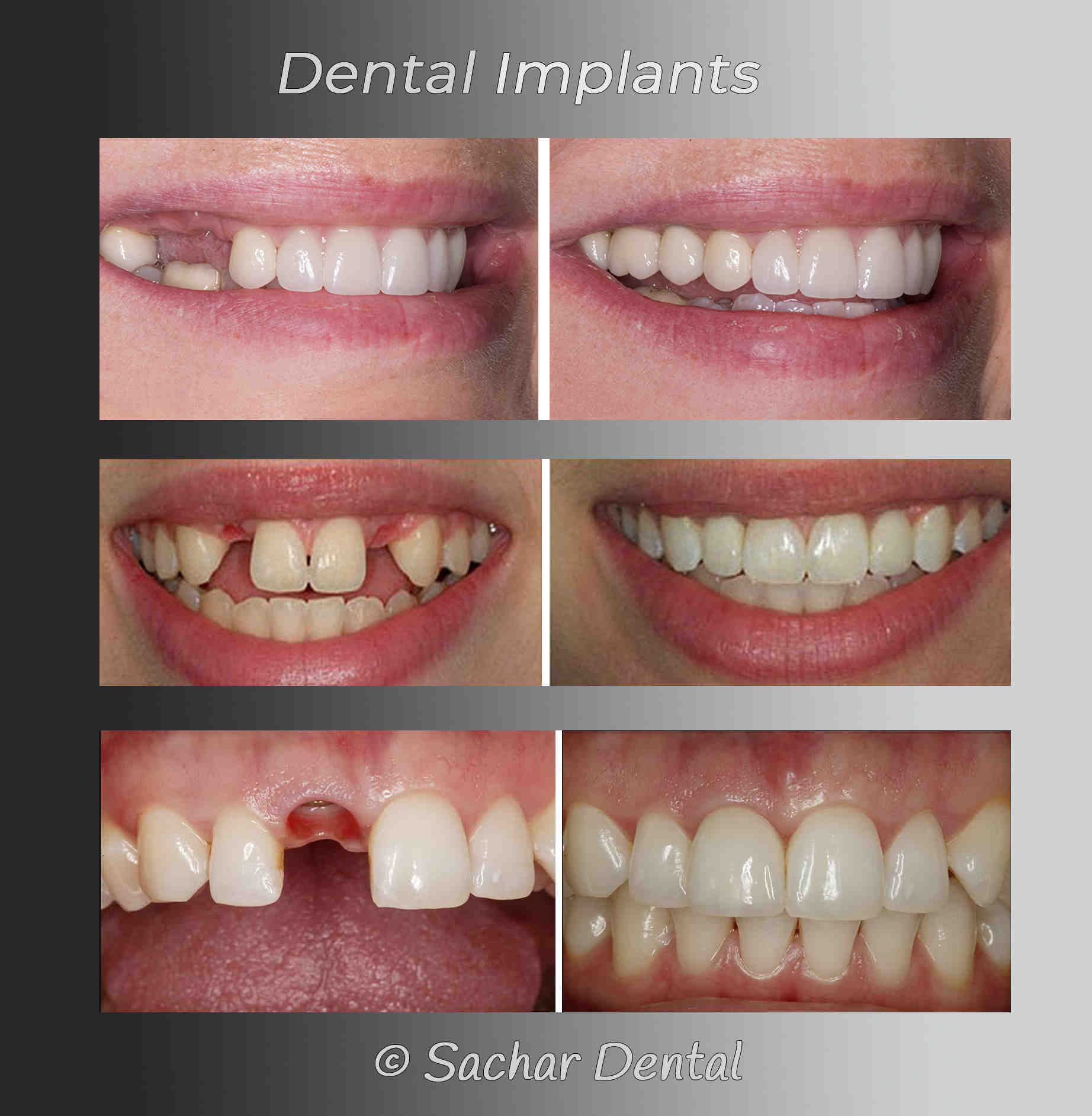 Which dental plan covers implants Dental News Network