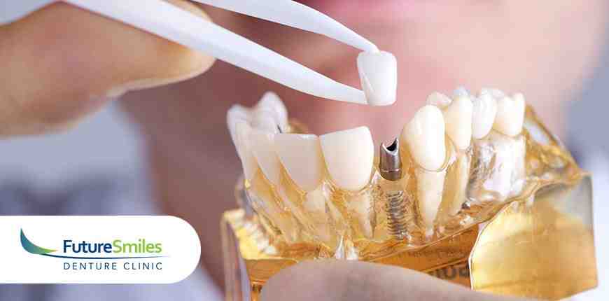 What is the best way to pay for dental implants?