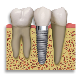 What is the cheapest dental implant?