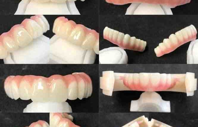 What is the cost of a dental implant