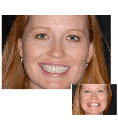 What is the cost of clear choice dental implants