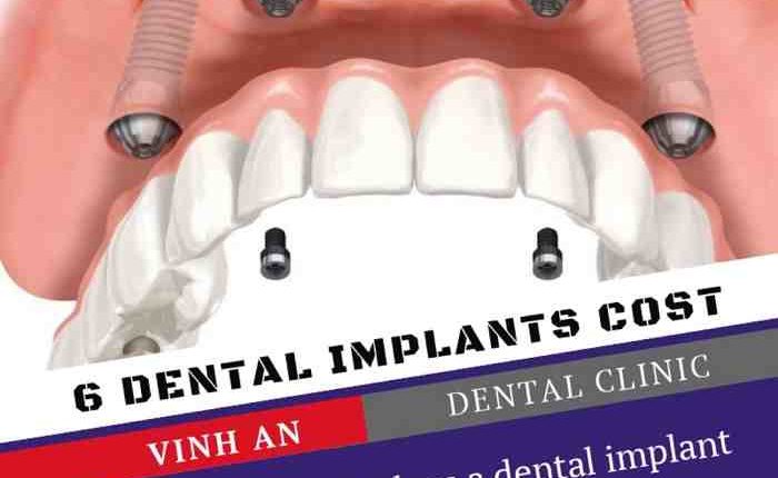 What is the cost of full dental implants