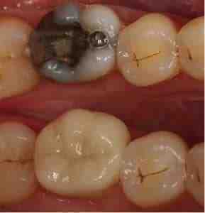 What is the downside of dental implants?