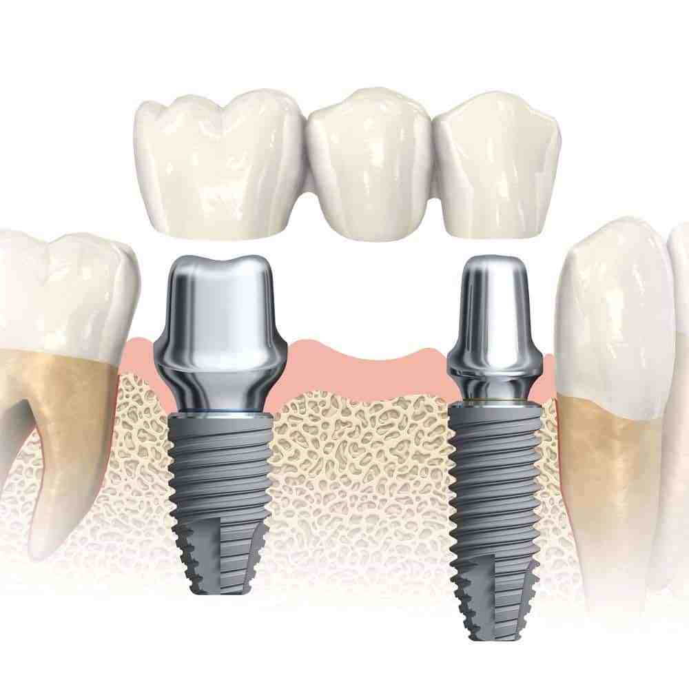 What is the downside of dental implants?