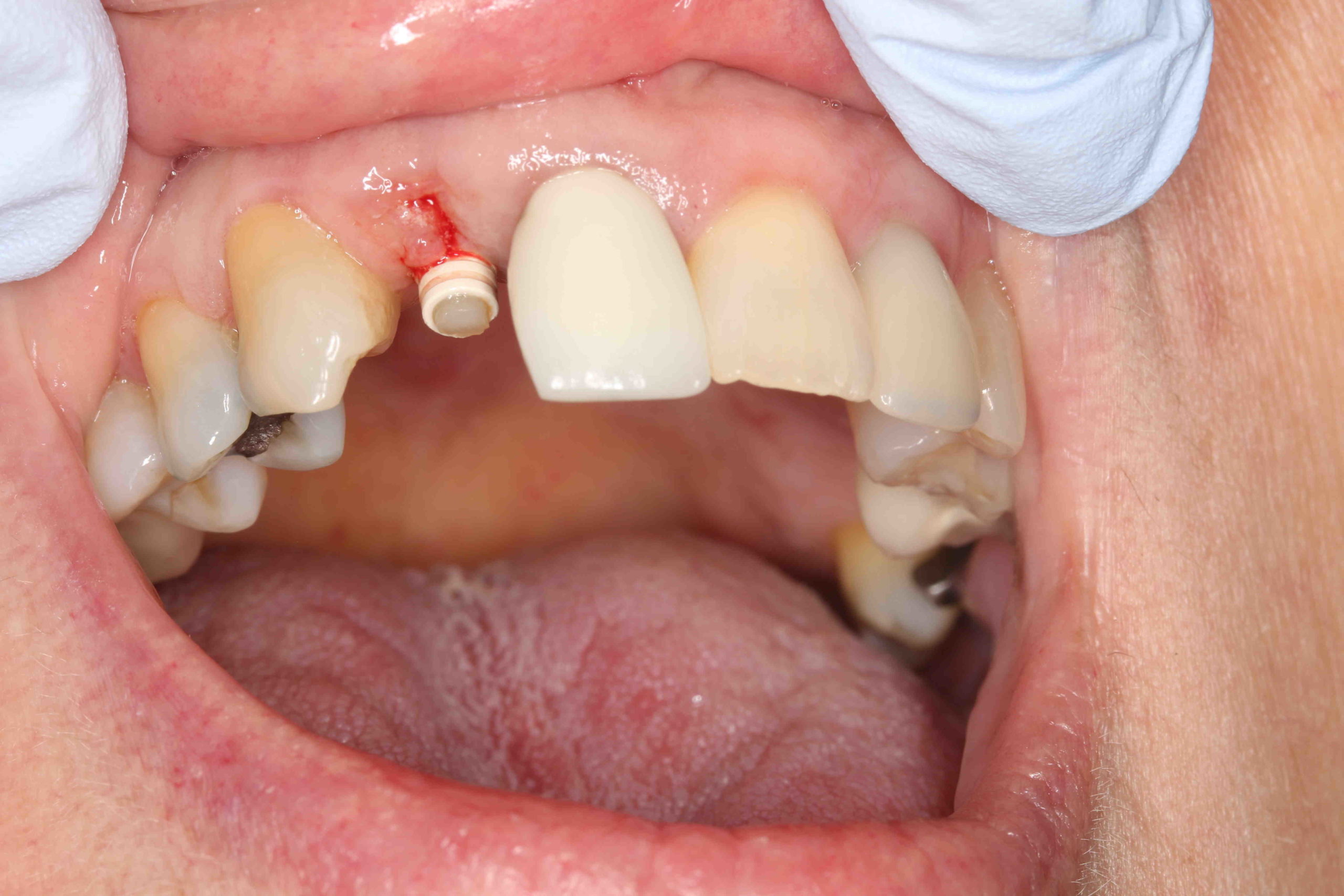What is the downside of dental implants?