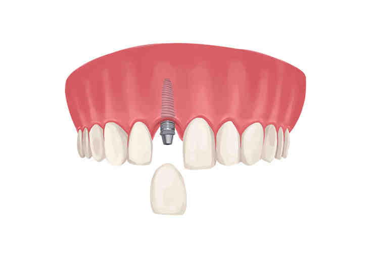 What is the downside of dental implants?