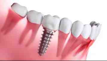 What is the downside of dental implants?