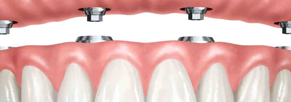 What is the lowest cost for dental implants?