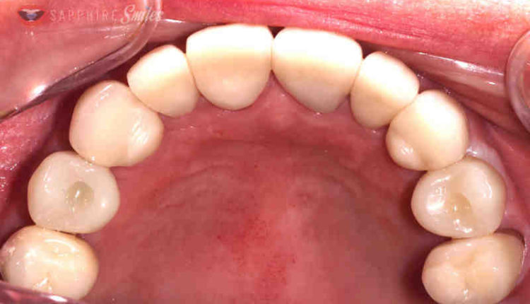 Who does dental implants near me