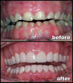 Who is not suitable for dental implants?