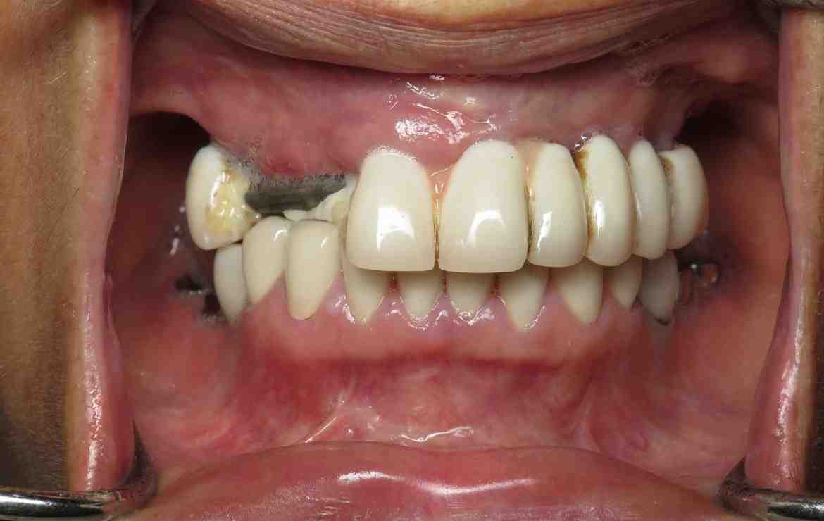 Who is not suitable for dental implants?
