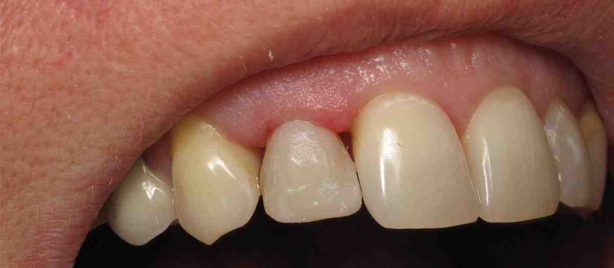 Why dental implants are bad?