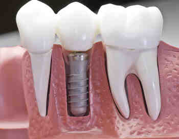 Why dental implants are not covered by insurance?