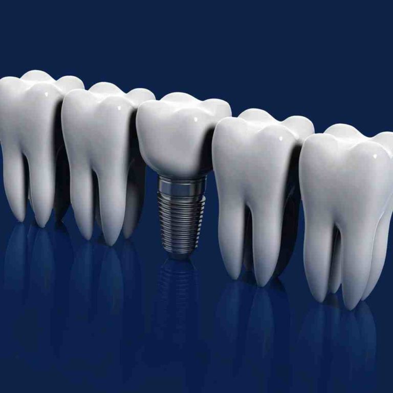 Will the va pay for dental implants Dental News Network
