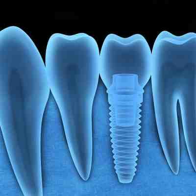 Will dental implants ever get cheaper?