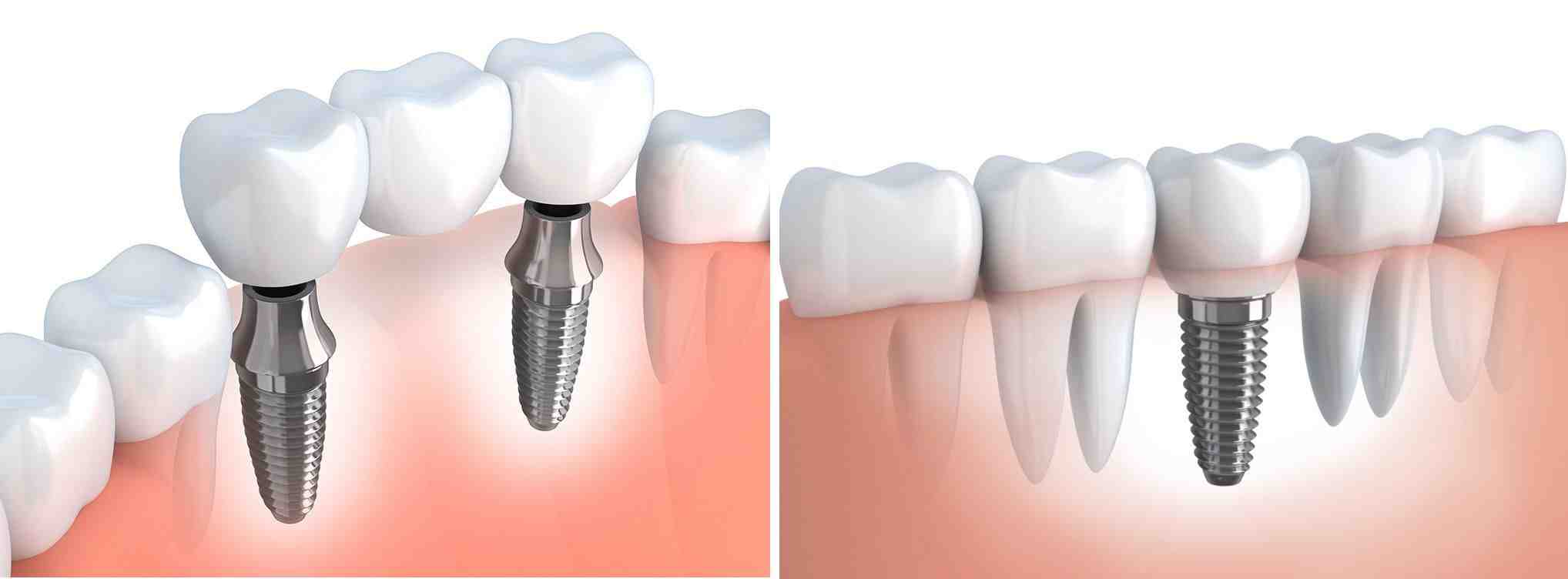 Will dental schools do implants?