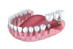 Will military pay for dental implants?