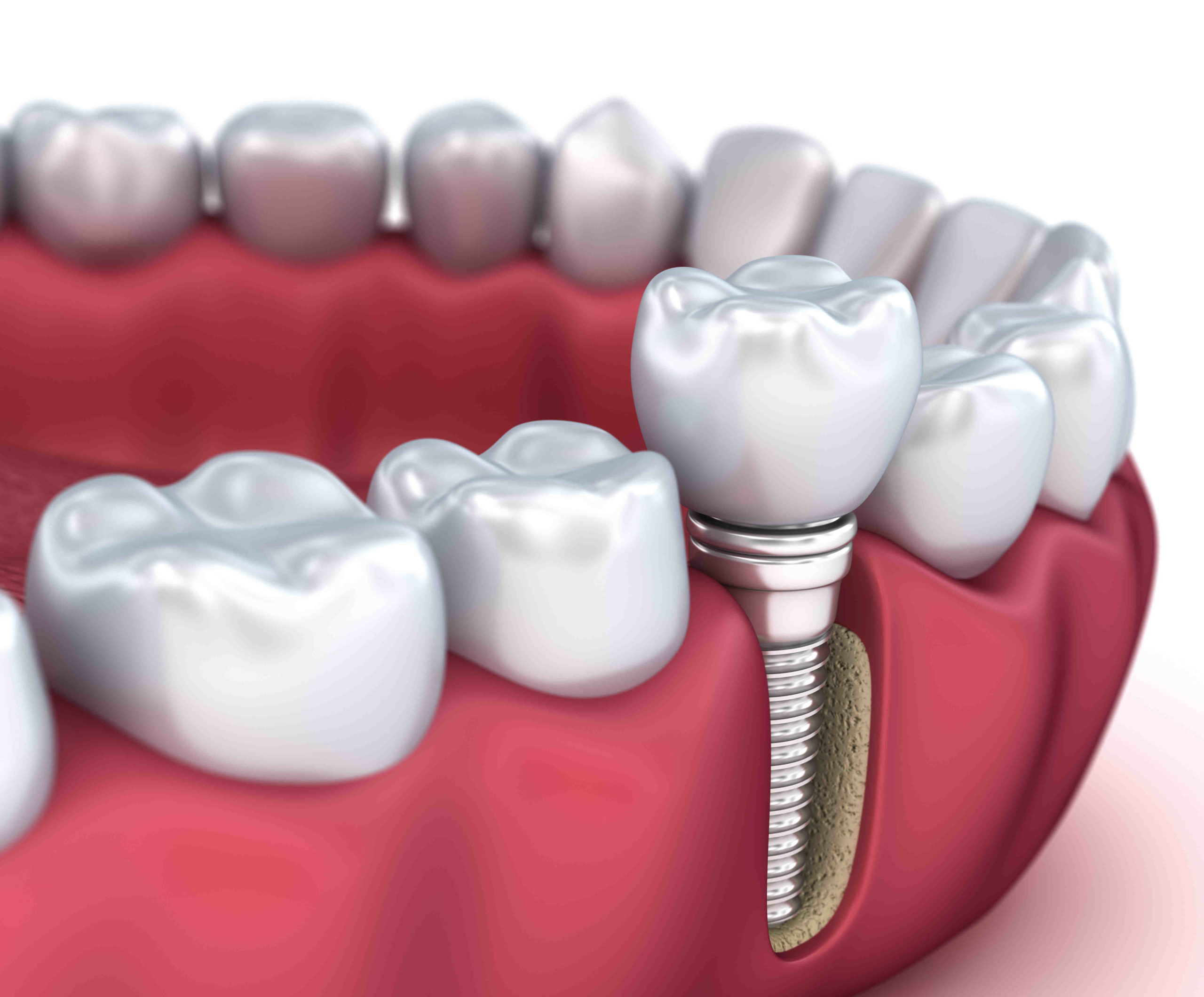 Will military pay for dental implants?