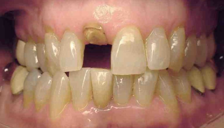 Will the va do dental implants