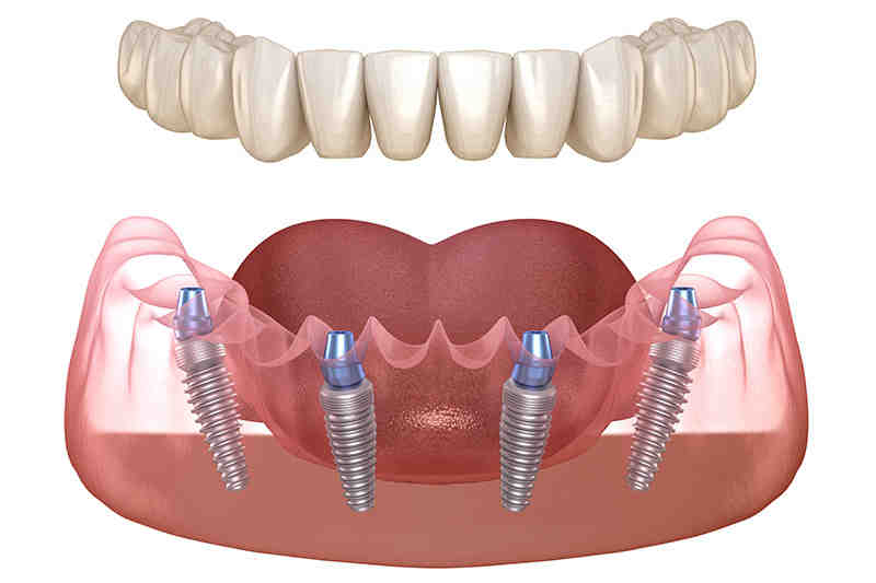 Are all on 4 dental implants removable?