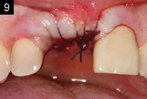 Are dental bone grafts necessary?