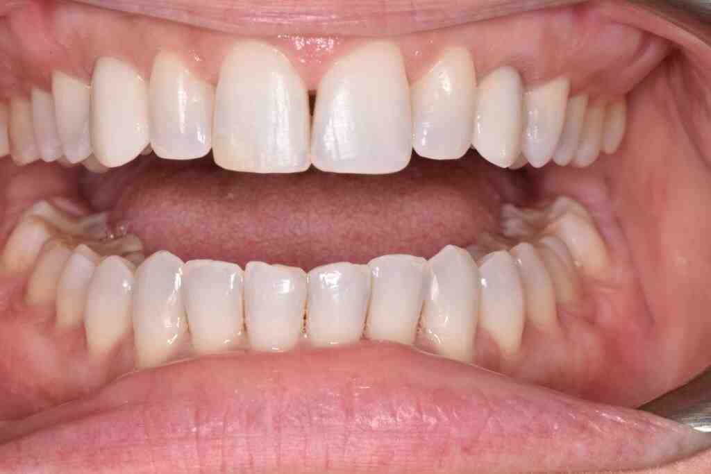 Do dental implants look fake Dental News Network