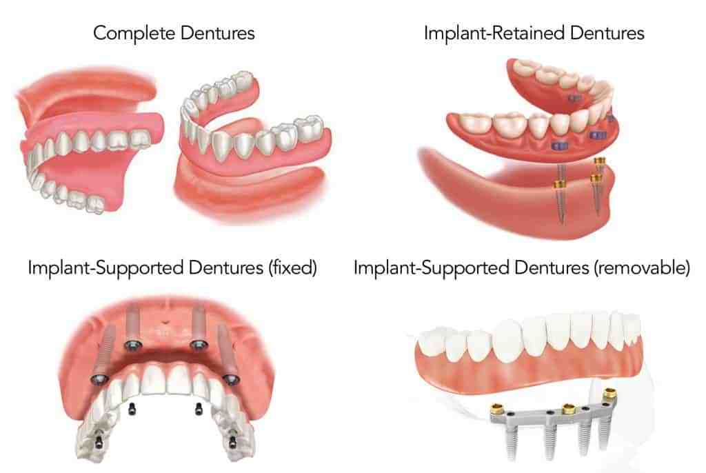 Are dental implants removable for cleaning?