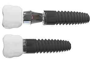 Are dental implants safe long term?