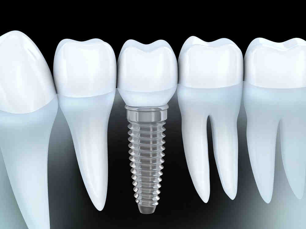 Are dental implants suitable for older people?