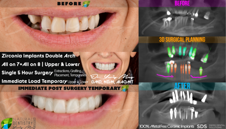 Are dental implants toxic