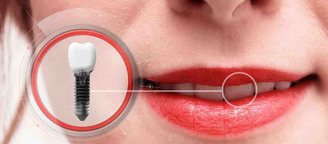 Are dental implants worth it?