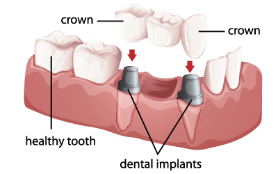 Are full mouth dental implants covered by insurance?