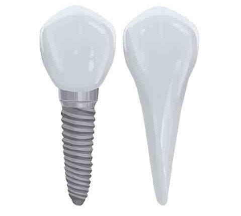 Are mini dental implants permanent