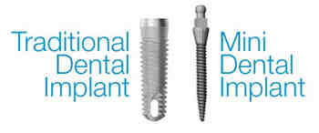 Are mini dental implants permanent?