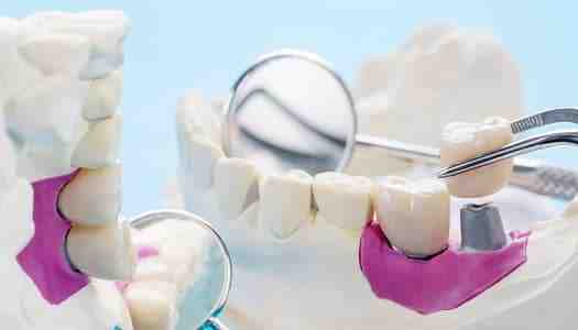 Are same day dental implants any good?