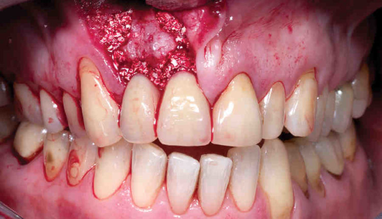 Are there dental implants from materials that don't cause reactions