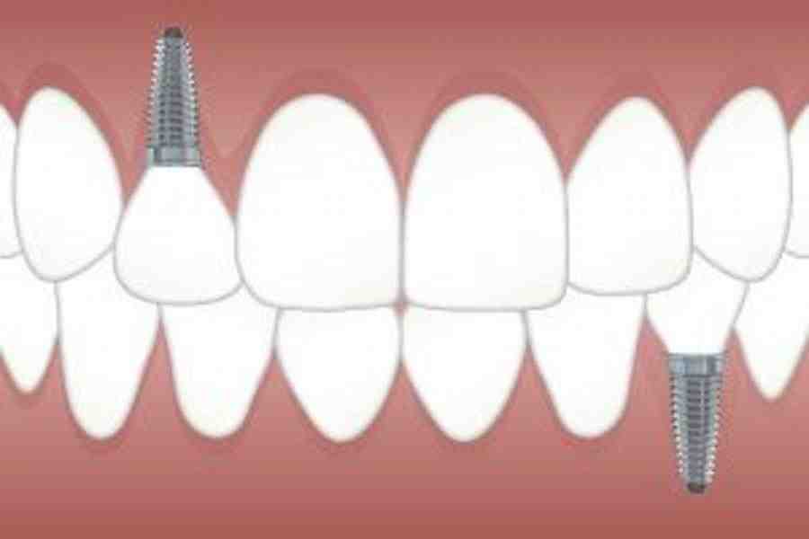 Are there non metal dental implants?