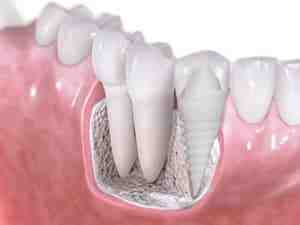 Are there non metal dental implants?