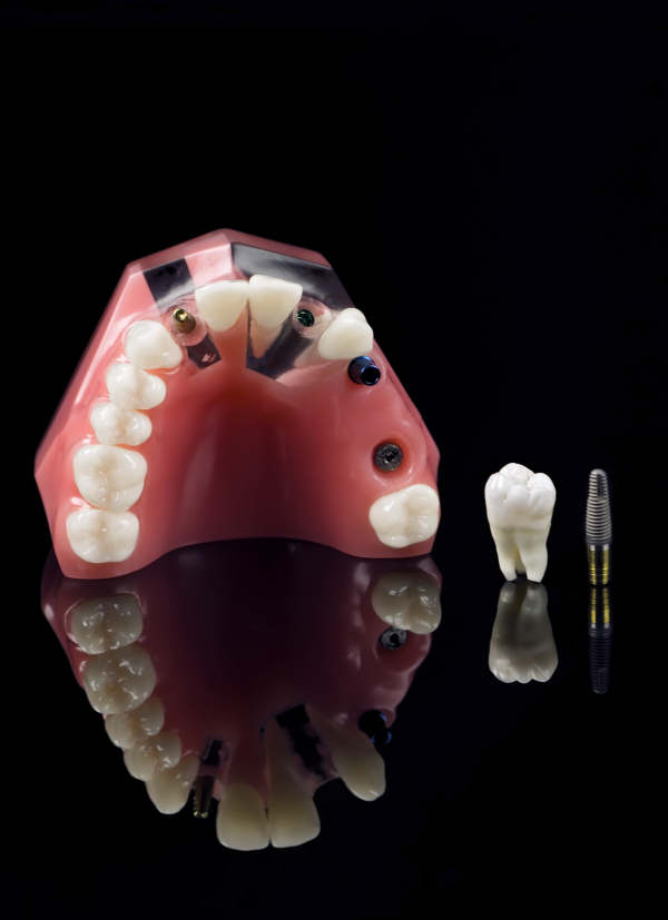 Is there an alternative use instead of titanium in dental implants