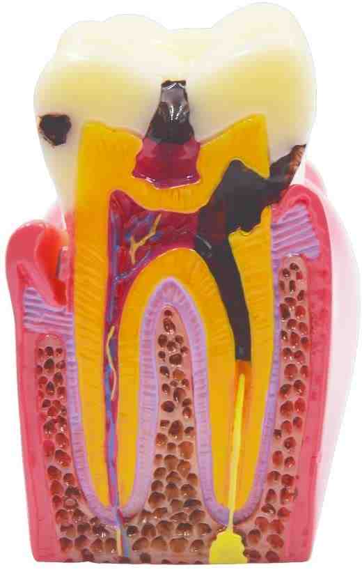 Are dental implants toxic Dental News Network