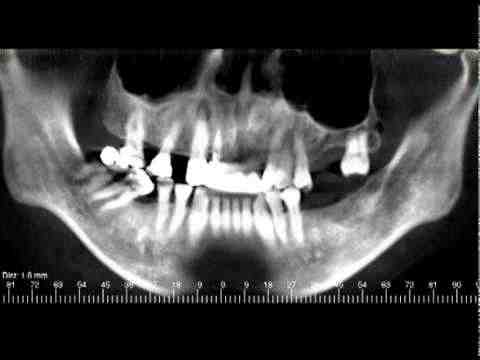 Can I have MRI if I have dental implants?